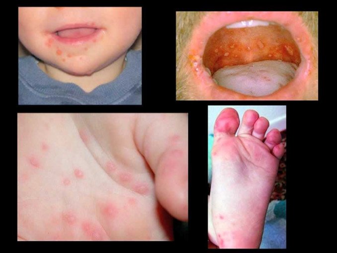 Çocuklarda el ayak ağız hastalığı